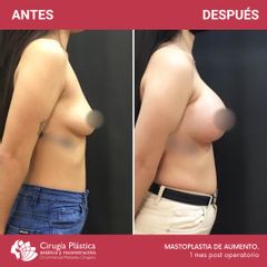 Aumento mamas - Dr. Emmanuel Manavela Chiapero