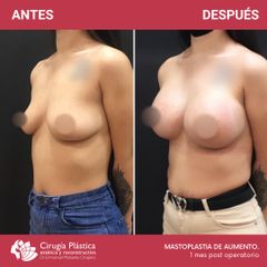 Aumento mamas - Dr. Emmanuel Manavela Chiapero