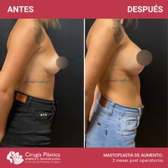 Aumento mamas - Dr. Emmanuel Manavela Chiapero