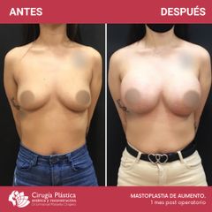 Aumento mamas - Dr. Emmanuel Manavela Chiapero