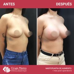 Aumento mamas - Dr. Emmanuel Manavela Chiapero