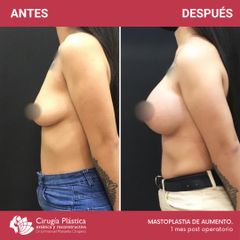 Aumento mamas - Dr. Emmanuel Manavela Chiapero