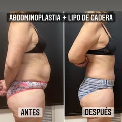 Abdominoplastia - Dr. Emmanuel Manavela Chiapero