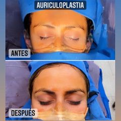 Otoplastia - Dr. Emmanuel Manavela Chiapero