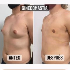 Ginecomastia - Dr. Emmanuel Manavela Chiapero