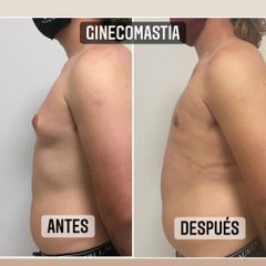 Ginecomastia - Dr. Emmanuel Manavela Chiapero