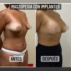 Mastopexia - Dr. Emmanuel Manavela Chiapero