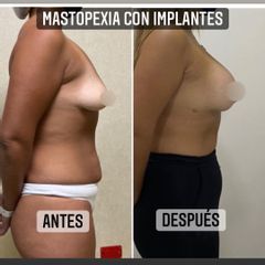 Mastopexia - Dr. Emmanuel Manavela Chiapero