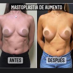 Aumento mamas - Dr. Emmanuel Manavela Chiapero