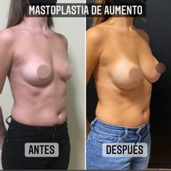 Aumento mamas - Dr. Emmanuel Manavela Chiapero