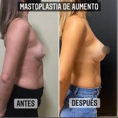 Aumento mamas - Dr. Emmanuel Manavela Chiapero