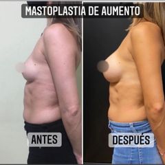 Aumento mamas - Dr. Emmanuel Manavela Chiapero