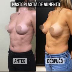 Aumento mamas - Dr. Emmanuel Manavela Chiapero