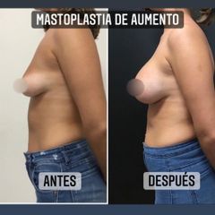 Aumento mamas - Dr. Emmanuel Manavela Chiapero