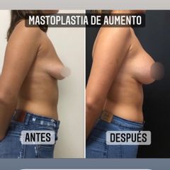 Aumento mamas - Dr. Emmanuel Manavela Chiapero