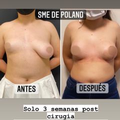 Mastopexia - Dr. Emmanuel Manavela Chiapero