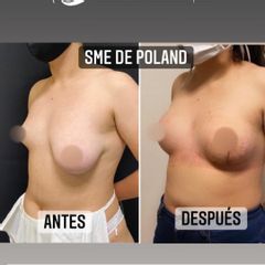 Mastopexia - Dr. Emmanuel Manavela Chiapero