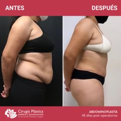 Abdominoplastia - Dr. Emmanuel Manavela Chiapero