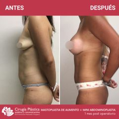 Aumento mamas - Dr. Emmanuel Manavela Chiapero