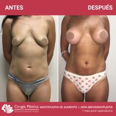 Aumento mamas - Dr. Emmanuel Manavela Chiapero