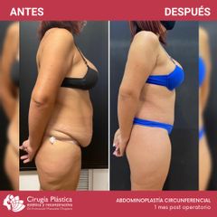 Abdominoplastia - Dr. Emmanuel Manavela Chiapero