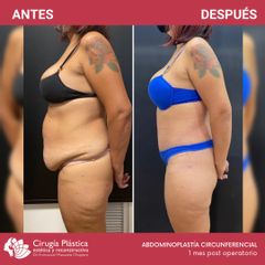 Abdominoplastia - Dr. Emmanuel Manavela Chiapero