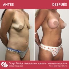 Aumento mamas - Dr. Emmanuel Manavela Chiapero