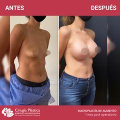 Aumento mamas - Dr. Emmanuel Manavela Chiapero