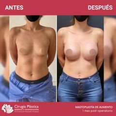 Aumento mamas - Dr. Emmanuel Manavela Chiapero