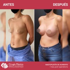 Aumento mamas - Dr. Emmanuel Manavela Chiapero