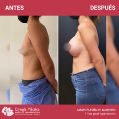Aumento mamas - Dr. Emmanuel Manavela Chiapero
