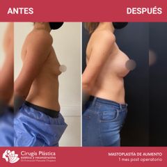Aumento mamas - Dr. Emmanuel Manavela Chiapero