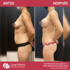 Aumento mamas - Dr. Emmanuel Manavela Chiapero