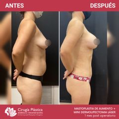 Aumento mamas - Dr. Emmanuel Manavela Chiapero