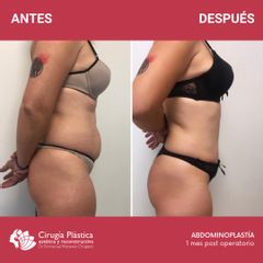 Abdominoplastia - Dr. Emmanuel Manavela Chiapero
