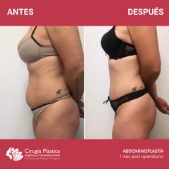 Abdominoplastia - Dr. Emmanuel Manavela Chiapero