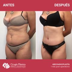 Abdominoplastia - Dr. Emmanuel Manavela Chiapero