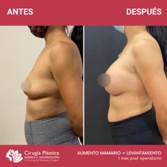 Aumento mamas - Dr. Emmanuel Manavela Chiapero