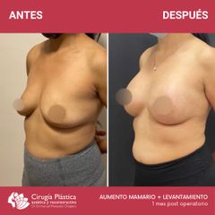 Aumento mamas - Dr. Emmanuel Manavela Chiapero