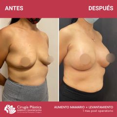 Aumento mamas - Dr. Emmanuel Manavela Chiapero