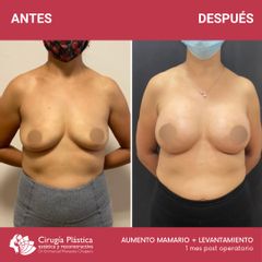 Aumento mamas - Dr. Emmanuel Manavela Chiapero