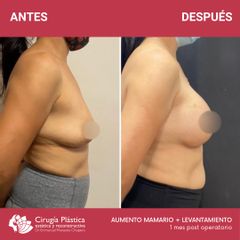 Aumento mamas - Dr. Emmanuel Manavela Chiapero