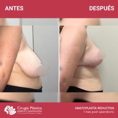 Reducción de mamas - Dr. Emmanuel Manavela Chiapero