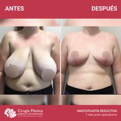 Reducción de mamas - Dr. Emmanuel Manavela Chiapero