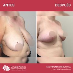 Reducción de mamas - Dr. Emmanuel Manavela Chiapero