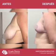 Reducción de mamas - Dr. Emmanuel Manavela Chiapero