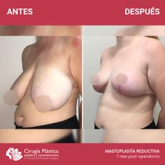 Reducción de mamas - Dr. Emmanuel Manavela Chiapero