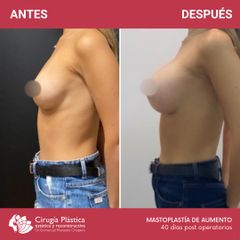 Aumento mamas - Dr. Emmanuel Manavela Chiapero