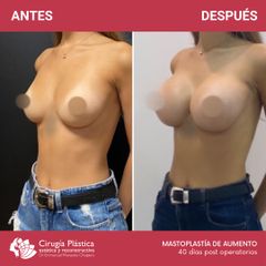 Aumento mamas - Dr. Emmanuel Manavela Chiapero