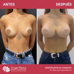 Aumento mamas - Dr. Emmanuel Manavela Chiapero
